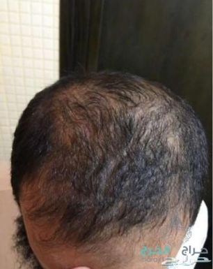 زيت الحشيش الأفغاني الاصلي 100%للتساقط وانبات فراغات وطالة الشعر منتج مضمون ومجرب