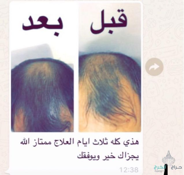 زيت الحشيش الأفغاني الاصلي 100%للتساقط وانبات فراغات وطالة الشعر منتج مضمون ومجرب