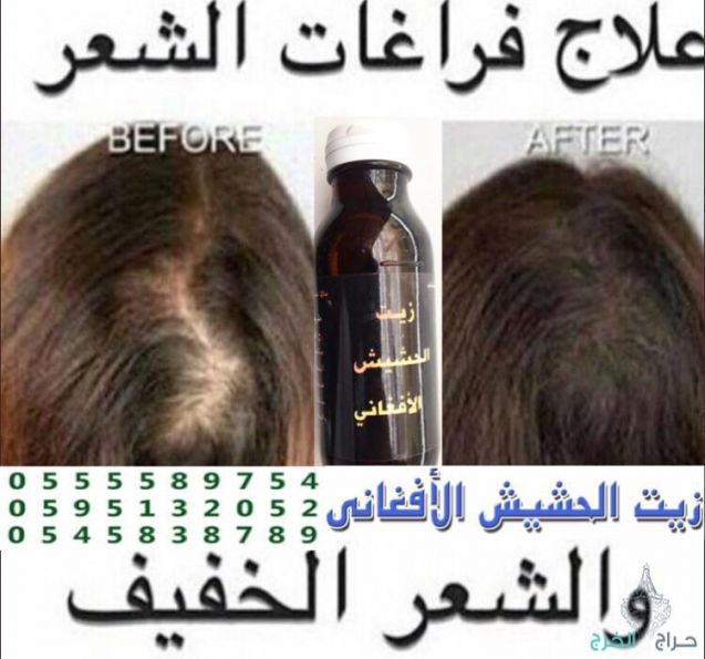 اقوى منتج للستاقط الشعر وانبات فراغات للرجال والنساء منتج مضمون مجرب ليسا اعلان ودعايه بل فعال مجرب