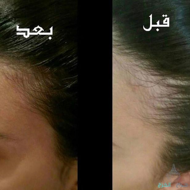 اقوى منتج للستاقط الشعر وانبات فراغات للرجال والنساء منتج مضمون مجرب ليسا اعلان ودعايه بل فعال مجرب